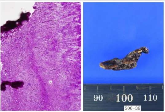 Figure 4.  Microscopy shows septated hyphae of Aspergillus with acute angulation (upper, PAS stain x400), and  gross picture shows the removed blackish stone-like material (lower).