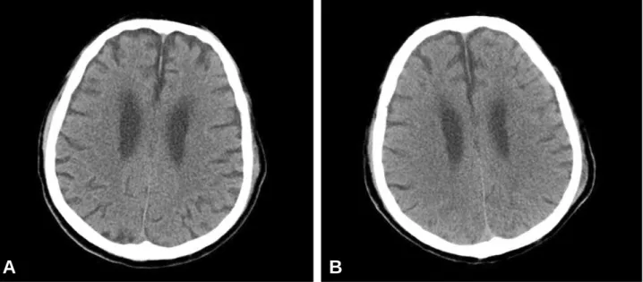 Fig. 1. The cerebral computed tomography (CT) scan findings. A CT scan on admission showed no evidence of acute intracranial hemorrhage, hydrocephalus or midline shifting, and detectable skull fracture (A)