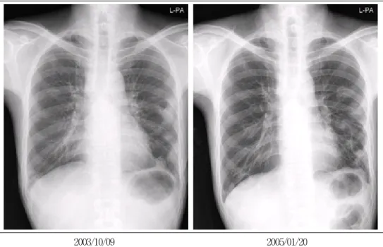 Figure 2.  At initial chest CT (A) shows multifocal consolidation with ground glass haziness and some cavitary  change in subpleural area of both lung