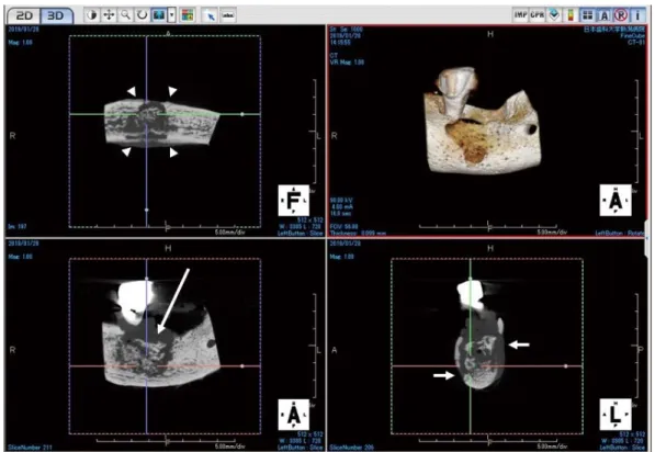 Fig. 2.  Cone-beam computed tomographic (CBCT) images of surgical specimen medication-related osteonecrosis of the jaw (case 3)