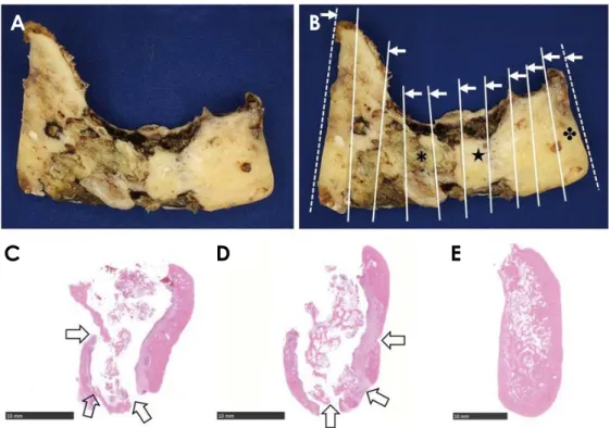 Fig. 6.  Histopathological characteristics of a surgical specimen of osteoradionecrosis of the jaw (case 9)