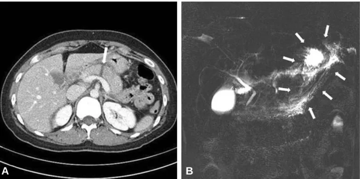 Fig. 2. On exploratory laparotomy, the pancreas was transect- transect-ed at the neck of pancreas and the superior mesenteric vein (white Arrow) was seen between the head and the body of the pancreas.