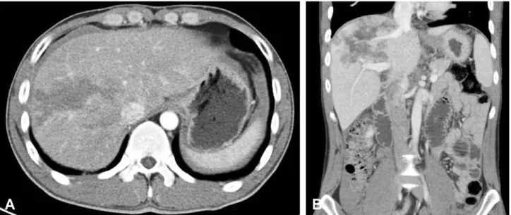 Fig. 1. Initial abdominal computed tomography showing hepatic laceration grade III (segment 7/8) with hemoperitoneum