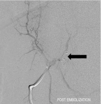 Fig. 4. Post embolization angiography showing no contrast enhancement in the portal vein after the deposition of embolization coils (arrow).