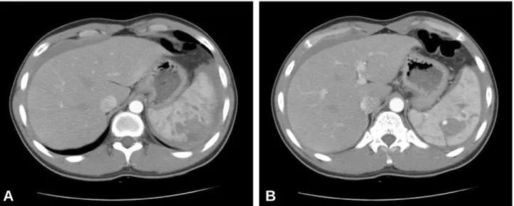 Fig. 2. Gross finding of injured spleen showed a ruptured splenic capsule, subcapsular hematoma in the spleen.