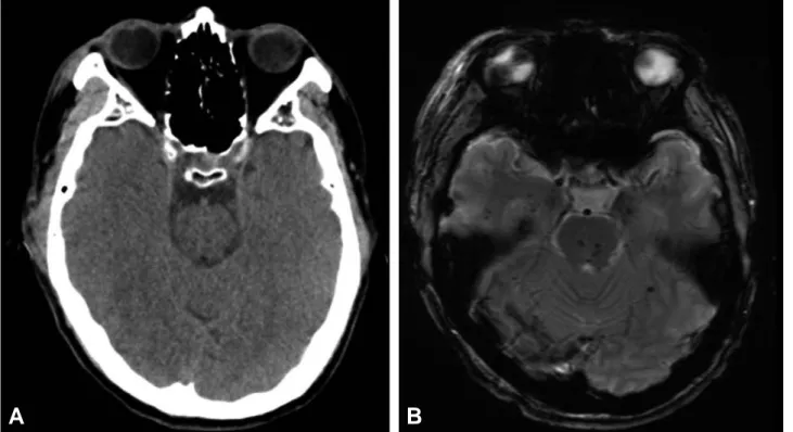 Fig. 1. Brain stem lesion on CT and GRI in a patient with DAI (A) does not show hemorrhgic brain stem lesion on CT