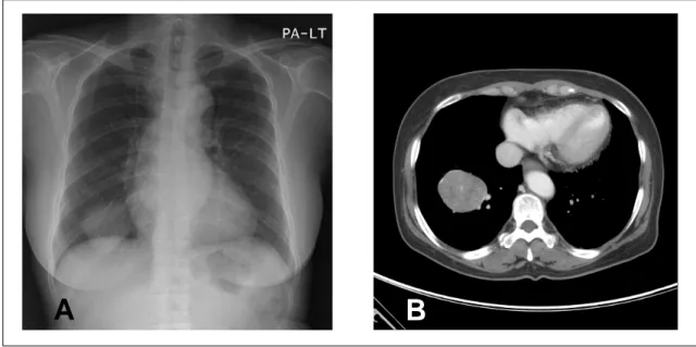 Figure 1.  (A) Chest radiograph shows right lower lobe mass. (B) On chest CT scan, 5ⅹ4cm sized well demarcated  and highly enhancing mass was noted in right lower lobe.