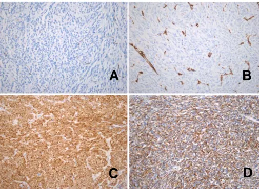 Figure 5.  The results of immunohistochemical stains. The tumor cells are completely negative for smooth muscle  actin (A; ⅹ400) and CD34 (B; ⅹ400)