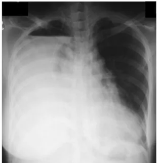 Figure  2.   Chest  PA  shows  massive  hydropneu- hydropneu-mothorax. The tip of catheter is broken away from  the former site