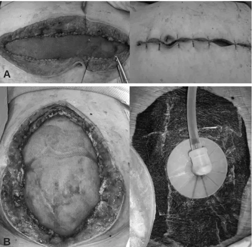 Fig. 1. Method of fascial closure. (A) During the abdominal wall closure, artificial mesh was applied in the fascial defect and the skin was approximated primarily