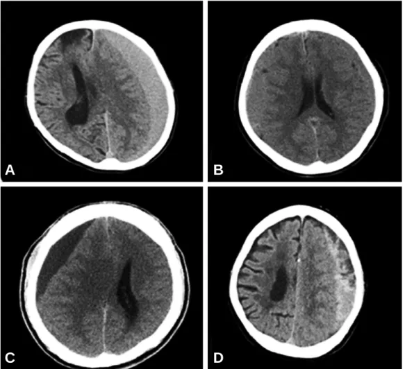 Fig. 1. Chronic subdural hematoma is classified according to its density on brain CT scans