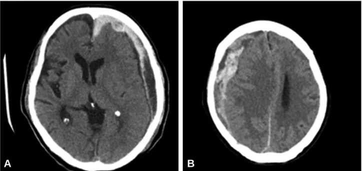 Fig. 5. Brain CT scans features of the patients with acute on chronic subdural hematoma.