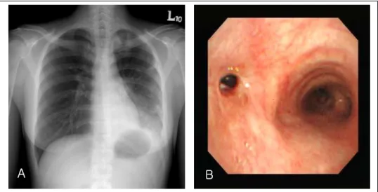 Figure  1.   Chest  radiograph  at  initial  visit  shows  infiltrations  with  volume  loss  of  the  left  lower  lung(A)