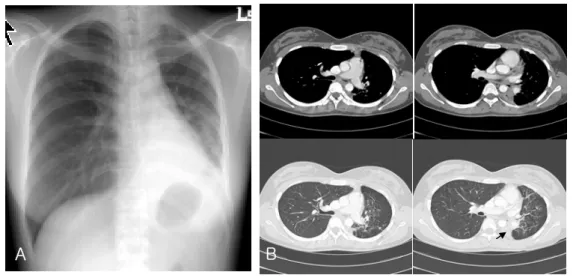 Figure 3.  After 4 months, complete atelectasis of the left lung is seen in chest radiograph(A) and bronchoscopy  demonstrates complete obstruction of the left main bronchus(B).