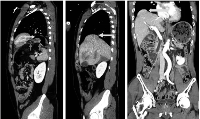 Fig. 1. Right-sided blunt traumatic diaphragm rupture in a 46-year-old man after a motor-vehicle accident