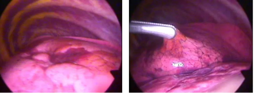 Figure 3.  Yellow-brown colored lesions were seen on the lateral surface of the lower lung, and also was dark-red  colored hemorrhagic area around the lesion