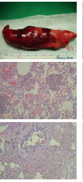 Figure  4.   Histologic  section  shows  intraalveolar  hemorrhage  and  aggregates  of  hemosiderin-laden  macrophage(H&amp;E, x16 and x200) 전체  폐를  자세히  관찰하여  다른  병변  부위가  없음을  확인하였고,  횡격막부위도  면밀히  관찰하였으나,  자 궁내막으로  의심되는  병변은  없었다