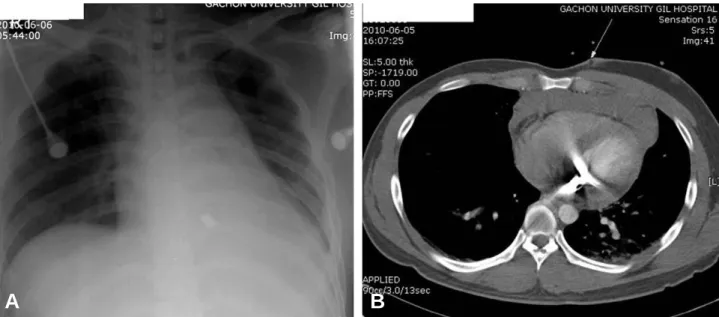 Fig. 1. (A) Simple chest radiography shows radiopaque material in the cardiac shadow. (B) Computed tomography shows the entry point (indicated by long arrow) and mediastinal hematoma and motion artifact made by metal fragment.