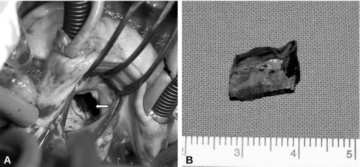 Fig. 3. A metal mass was found below the mitral valve (A) and removed (B).