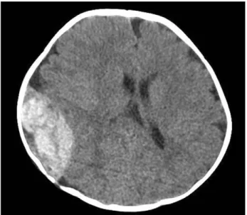 Fig. 2. Brain CT showing no visualization of remained epidur- epidur-al hematoma or newly developed lesion