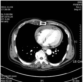 Fig. 1. Contrast enhanced CT scan shows hemorrhagic fluid collection in the pericardium.