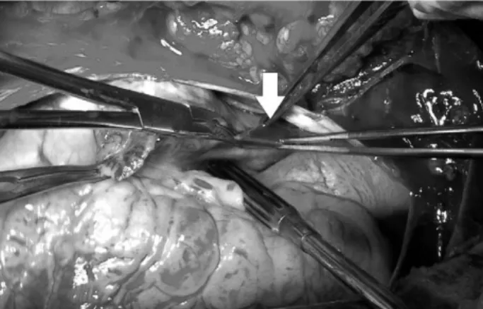 Fig. 4. Linear laceration on superior vena cava (arrow)