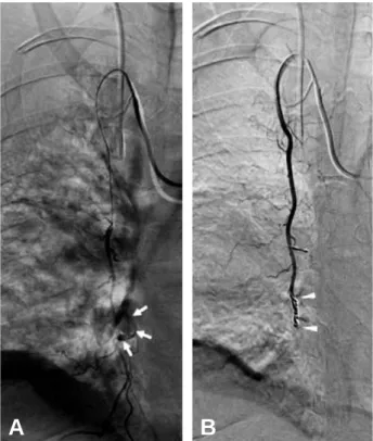 Fig. 3. Selective right internal mammary artery angiogram. (A) Arrows indicate an area of extravasation from  perforat-ing branch of internal mammary artery