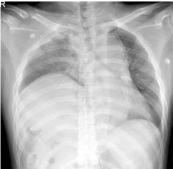 Fig. 2. CT shows liver &amp; colon herniation to the right thorax.
