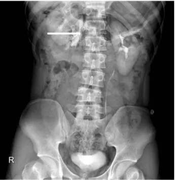 Fig. 3. Abdominal x-ray performed after contrast-enhanced CT shows leakage of contrast material from the right ureter(arrow).