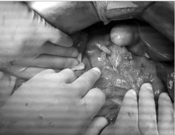 Fig. 2. Photography of intraoperative finding showing perfora- perfora-tion of the second porperfora-tion of the duodenum.