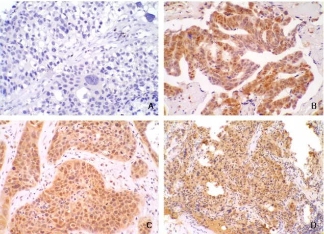 Figure 1 . Immunohistochemical staining for HO-1. (A) negative HO-1 expression (×200), (B) positive  HO-1 expression in adenocarcinoma (×200), (C) positive HO-1 expression in squamous cell carcinoma  (×200), (D) positive HO-1 expression in non-small cell l