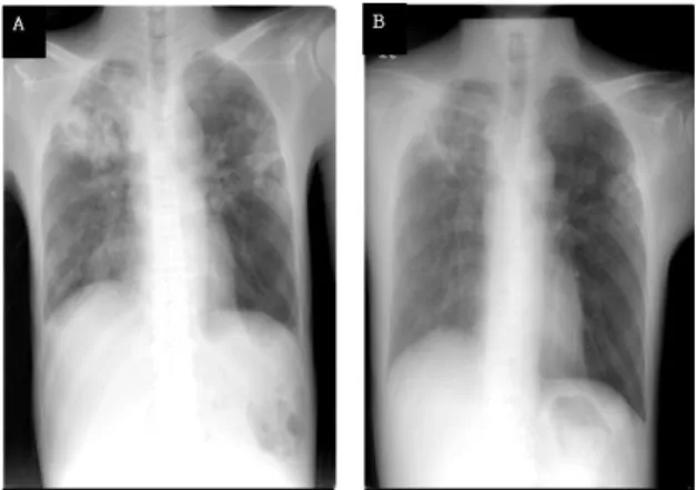 Figure 2.  Serial spinal MRI findings.