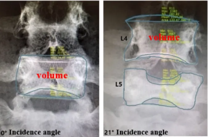 Figure 2. Distortion area measurement using PACS program (marosis, marotech) 