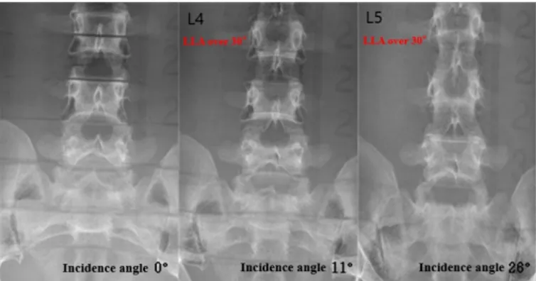 Figure 3. L4 and L5 body AnteroPosterior radiography image applied to incident angle by using the phantom 
