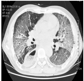 Figure 1. (A) On admission, chest radiograph shows diffuse bilateral ground‐glass shadowing, especially over  the middle and lower lung fields