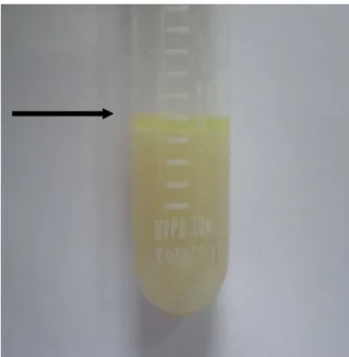 Figure 4. Light microscopic finding from BAL shows  numerous red staining positive fat materials ( Oil Red  O stain, X400)