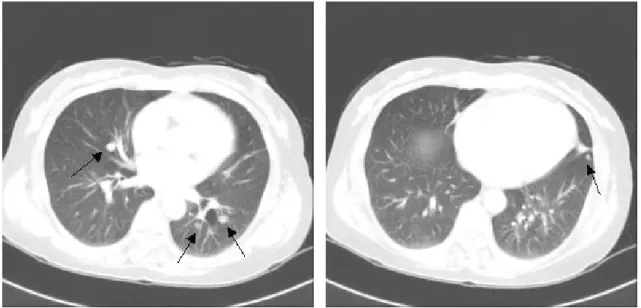 Figure 1.  CT scan reveals multiple nodular opacities on both lung fields.
