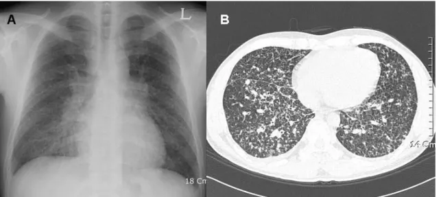 Figure 1.  Chest radiography (A) and high resolution computed tomography (B) on admission showed diffuse,  multiple, and small nodules with interlobular septal thickening on both whole lung field.