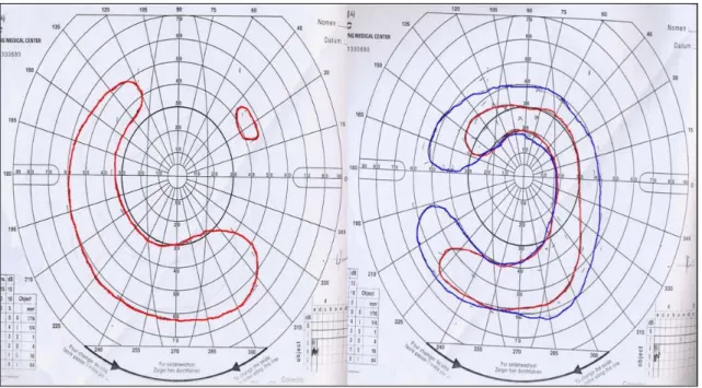 Figure  2.   Perimetry  finding  of  the  both  eyes  show  scotoma  in  central  area  of  the  visual  field.