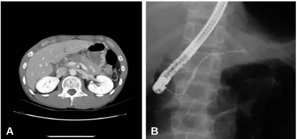 Fig. 2. (A) Initial CT scan of a 30-year old patient with main pancreatic ductal leakage and pancreatic pseudocyst
