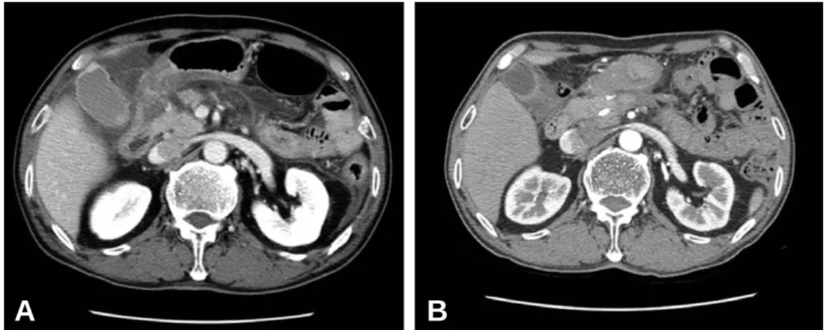Fig. 5. (A) Initial CT image of a patient who underwent therapeutic ERCP after trauma