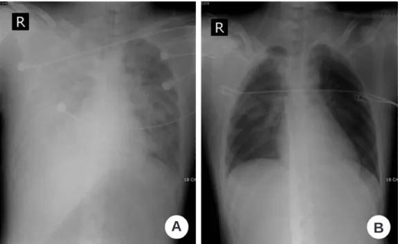 Table 1. Hospital course of the case-1 (20-year-old man) treated with Veno-Veno ECMO