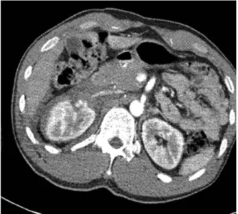 Fig. 1. Computed tomography scan showing extravasation of right renal artery and subcapsular hematoma in the right kidney and perirenal space.