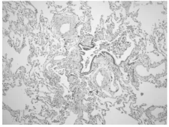 Figure  3. Respiratory  bronchiolitis  pattern,  with  marked  alveolar  macrophage  accumulation  in  and  around  bro