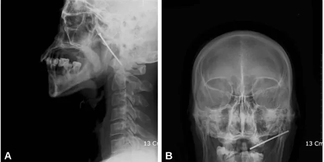 Fig. 2. Radiologic finding of patient with a foreign body of nail 6.3 cm in length