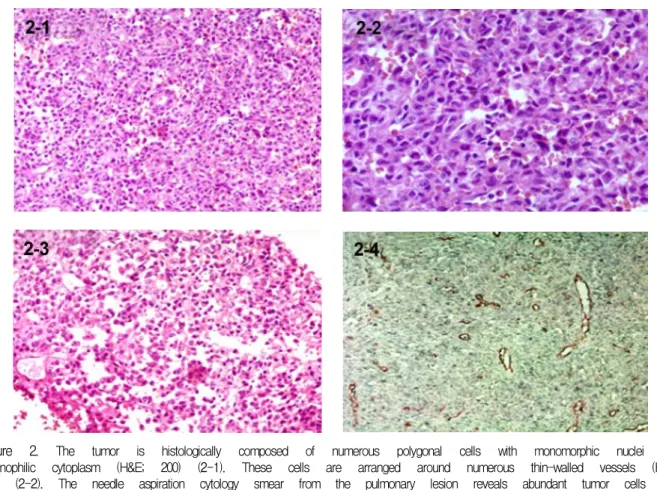 Figure  2. The  tumor  is  histologically  composed  of  numerous  polygonal  cells  with  monomorphic  nuclei  and  eosinophilic  cytoplasm  (H&amp;E;  200)  (2-1)