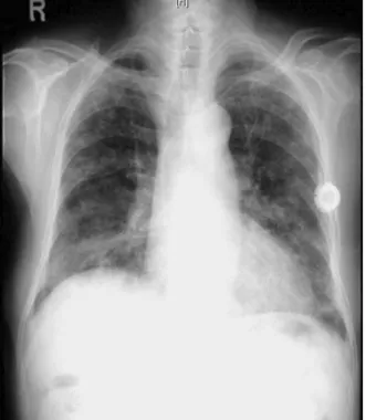 Figure  1.   Chest  PA  showed  diffuse  and  patchy  ground 