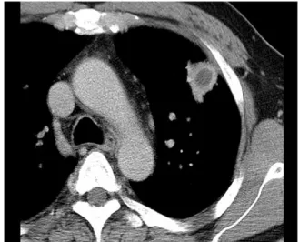 Figure  1.   50-year-old  man  with  an  early  stage  of  pa