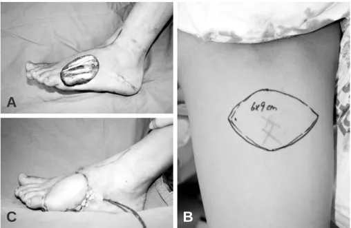 Fig. 1. (A) Intraoperative photograph, 6×8 cm sized foot dorsum defect with tendon exposure