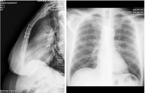 Fig. 1. Open reduction and fixation of sternum with longitudinal plate (left) and T-shaped plate (right).